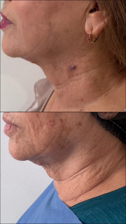Cuello y mentón de una paciente, antes (arriba) y después (abajo)