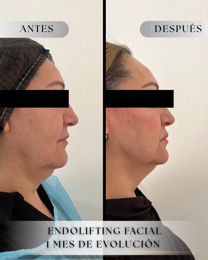 Perfil de una paciente, antes y después de Endolifting facial a 1 mes